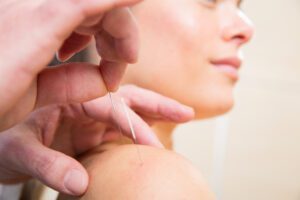 Kvinde som bliver behandlet med akupunktur imod hivedpine og migræne